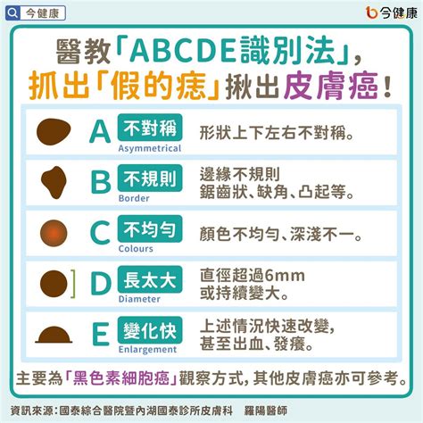 痣變大變凸|是痣or皮膚癌？醫「1張圖秒對照」 長這2部位最危險